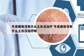 牛皮癬有沒(méi)有什么土辦法治療 牛皮癬有沒(méi)有什么土辦法治療呢