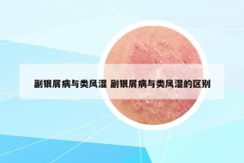 副銀屑病與類風(fēng)濕 副銀屑病與類風(fēng)濕的區(qū)別
