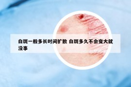 白斑一般多長時間擴(kuò)散 白斑多久不會變大就沒事