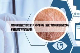 銀屑病偏方快來長春華山 治療銀屑病最權(quán)威的醫(yī)院專家是誰
