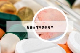 趙霖治療牛皮癬方子