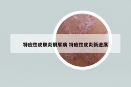 特應性皮膚炎銀屑病 特應性皮炎新進展