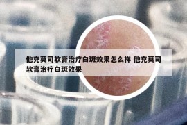 他克莫司軟膏治療白斑效果怎么樣 他克莫司軟膏治療白斑效果
