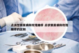 點(diǎn)滴性銀屑病和玫瑰糠疹 點(diǎn)狀銀屑病和玫瑰糠疹的區(qū)別