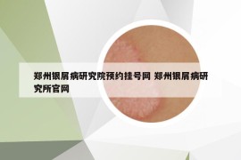 鄭州銀屑病研究院預約掛號網 鄭州銀屑病研究所官網