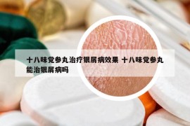 十八味黨參丸治療銀屑病效果 十八味黨參丸能治銀屑病嗎