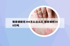 銀屑病做完308怎么這么紅 銀屑病照308行嗎