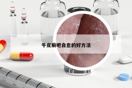 牛皮癬吧自愈的好方法