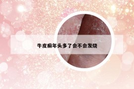 牛皮癬年頭多了會不會發(fā)燒
