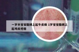 一歲半寶寶胳膊上起牛皮癬 1歲寶寶胳膊上起雞皮疙瘩
