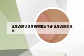 兒童點滴狀銀屑病哪里治療好 兒童點滴型銀屑