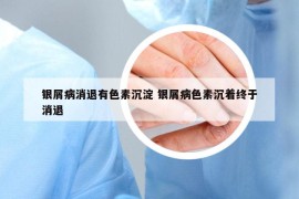銀屑病消退有色素沉淀 銀屑病色素沉著終于消退