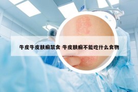 牛皮牛皮膚癬禁食 牛皮膚癬不能吃什么食物