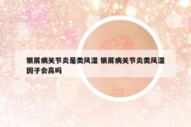 銀屑病關(guān)節(jié)炎是類風(fēng)濕 銀屑病關(guān)節(jié)炎類風(fēng)濕因子會高嗎