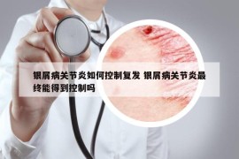 銀屑病關(guān)節(jié)炎如何控制復(fù)發(fā) 銀屑病關(guān)節(jié)炎最終能得到控制嗎