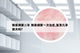 銀屑病第二年 銀屑病第一次治愈,復發(fā)幾率很大嗎?