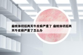扁桃體切后兩天牛皮癬嚴(yán)重了 扁桃體切后兩天牛皮癬嚴(yán)重了怎么辦