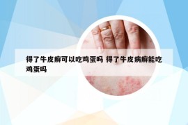 得了牛皮癬可以吃雞蛋嗎 得了牛皮病癬能吃雞蛋嗎