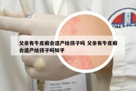 父親有牛皮癬會遺產(chǎn)給孩子嗎 父親有牛皮癬會遺產(chǎn)給孩子嗎知乎