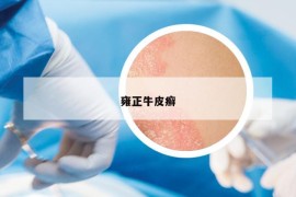 雍正牛皮癬