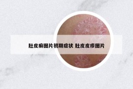 肚皮癬圖片初期癥狀 肚皮皮疹圖片