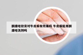 酮康唑軟膏對(duì)牛皮癬有效果嗎 牛皮癬能用酮康唑洗劑嗎