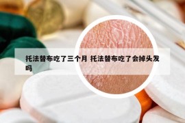 托法替布吃了三個(gè)月 托法替布吃了會(huì)掉頭發(fā)嗎