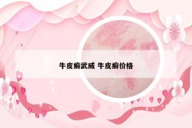 牛皮癬武威 牛皮癬價(jià)格