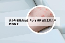 青少年銀屑病治愈 青少年銀屑病治愈的幾率大嗎知乎