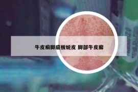 牛皮癬腳底板蛻皮 腳部牛皮廨