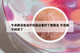 牛皮癬沒有治療但是這里好了那里出 牛皮癬不掉皮了