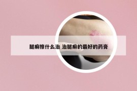 腿癬擦什么治 治腿癬的最好的藥膏
