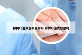 柳樹(shù)葉泡澡治牛皮癬嗎 柳樹(shù)葉治皮膚病嗎
