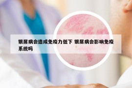 銀屑病會(huì)造成免疫力低下 銀屑病會(huì)影響免疫系統(tǒng)嗎
