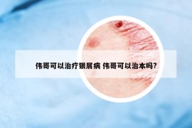 偉哥可以治療銀屑病 偉哥可以治本嗎?