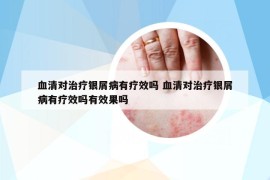 血清對(duì)治療銀屑病有療效嗎 血清對(duì)治療銀屑病有療效嗎有效果嗎