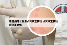 銀屑病可以服用貞芪扶正顆粒 貞芪扶正顆粒能治皮膚癢