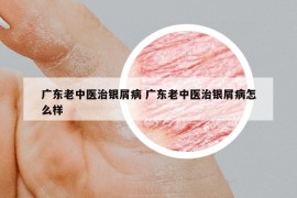 廣東老中醫(yī)治銀屑病 廣東老中醫(yī)治銀屑病怎么樣
