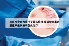 皮屑檢查出大量孢子是頭癬嗎 皮屑檢查出大量孢子是頭癬嗎怎么治療