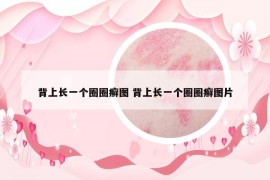 背上長一個圈圈癬圖 背上長一個圈圈癬圖片
