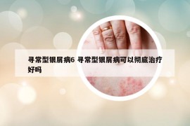 尋常型銀屑病6 尋常型銀屑病可以徹底治療好嗎