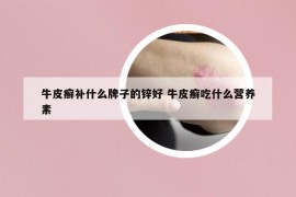 牛皮癬補(bǔ)什么牌子的鋅好 牛皮癬吃什么營養(yǎng)素