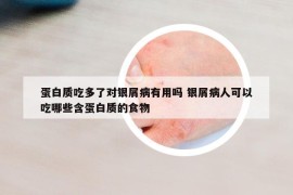 蛋白質(zhì)吃多了對銀屑病有用嗎 銀屑病人可以吃哪些含蛋白質(zhì)的食物