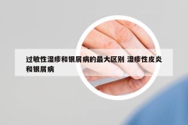 過(guò)敏性濕疹和銀屑病的最大區(qū)別 濕疹性皮炎和銀屑病
