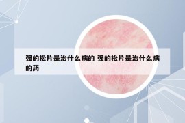 強(qiáng)的松片是治什么病的 強(qiáng)的松片是治什么病的藥