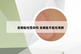 皮癬能吃茭白嗎 皮癬能不能吃海鮮