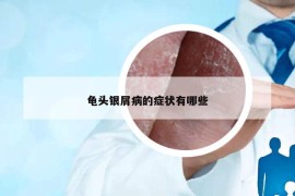 龜頭銀屑病的癥狀有哪些