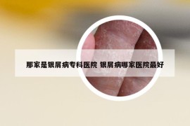 那家是銀屑病專科醫(yī)院 銀屑病哪家醫(yī)院最好