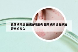 銀屑病用康復(fù)新液管用嗎 銀屑病用康復(fù)新液管用嗎多久