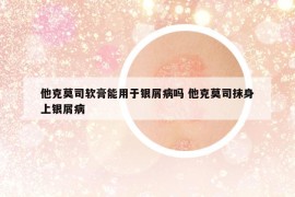 他克莫司軟膏能用于銀屑病嗎 他克莫司抹身上銀屑病
